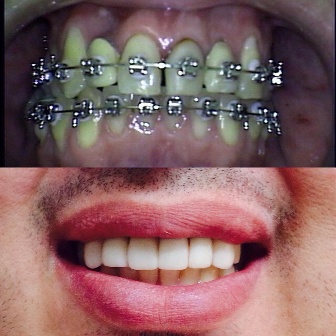 Tratamento Ortodôntico — antes e depois